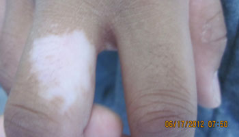 出现在手指头上一块白斑可能是白癜风吗