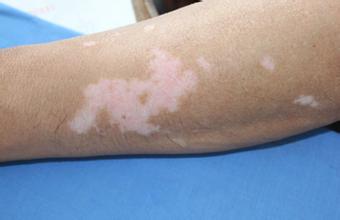 夏季白癜风，如何做好清洁很关键