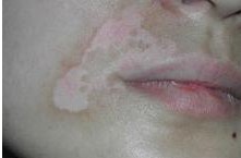 嘴唇部位的白癜风可以怎么去治疗