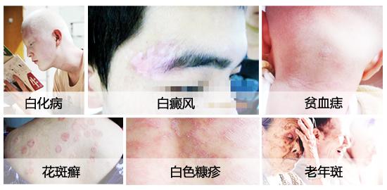 注意：这几大元凶会加重白癜风病情!