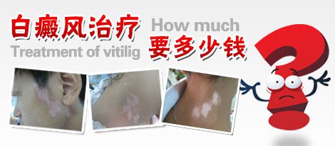 脸上白癜风治疗很贵吗