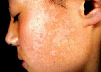 面部白斑莫小瞧，正确疗法很关键