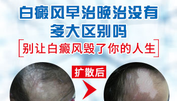 石家庄医院治疗白癜风一般多长时间见效