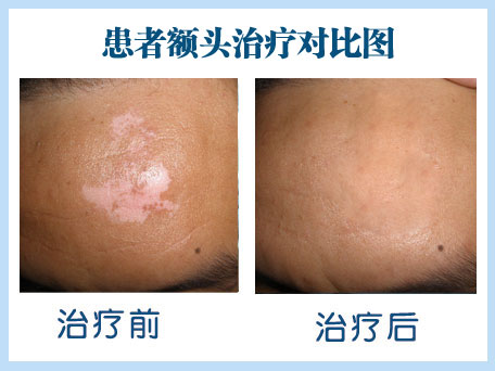 腹部白癜风治疗jpg