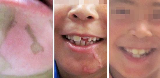 如何避免局限性白癜风扩散?妙招在这里