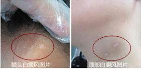 手术治疗白癜风多长时间好啊