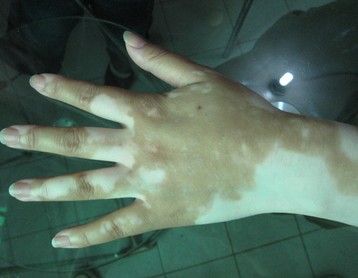 手上的白癜风容不容易治疗呢