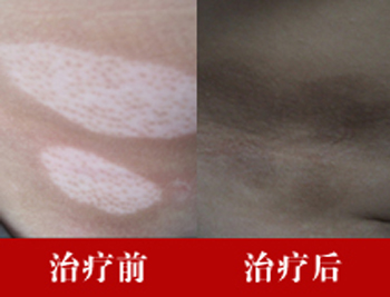 男性胳膊上有外伤会导致白癜风吗