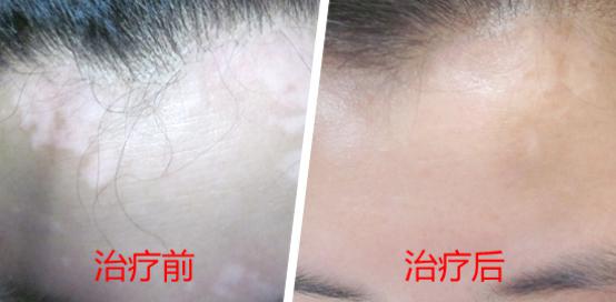 伍德灯检查白癜风多少钱