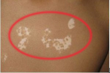 遗传白癜风治疗