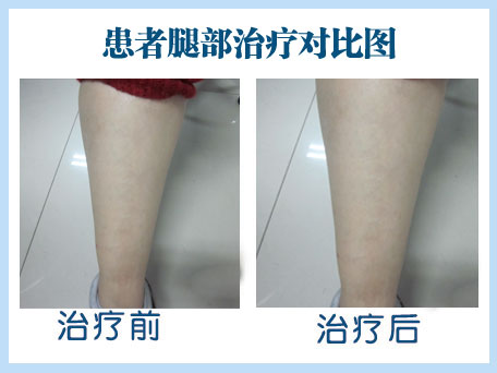 白癜风反复发作不要急