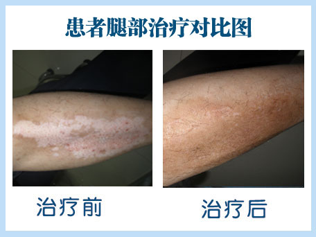 腿部白癜风要怎么治疗才好