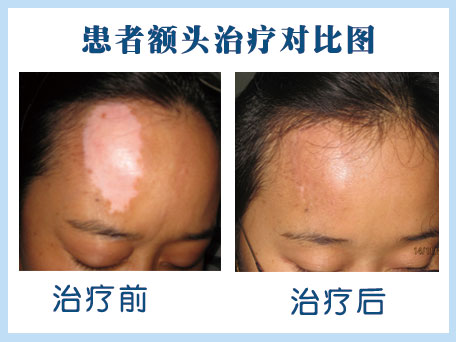 女性白癜风治疗