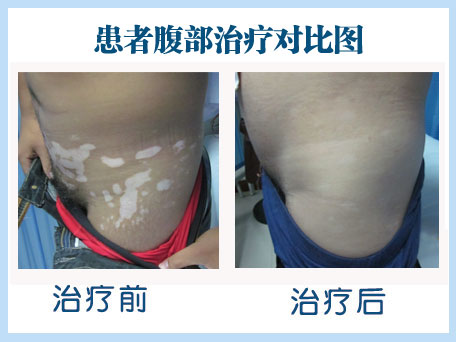 你是怎么看待白癜风的?治疗白癜风做的对不对