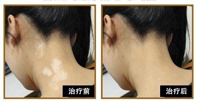 白癜风治疗