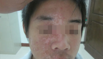 白癜风治疗贵不贵啊?小心别被“坑”