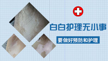 治疗白癜风怎么才是科学的护理之道