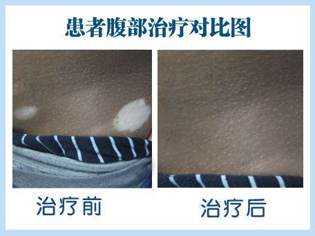 如何科学治疗泛发型白癜风