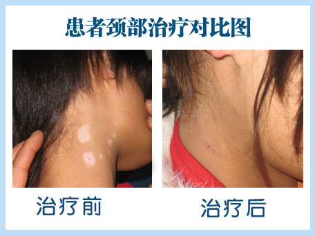 脖子的白癜风能种黑色素吗