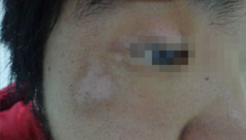 眼皮上长了个小白点是白癜风不