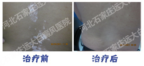 背部发现白癜风早期抹药能不能治好