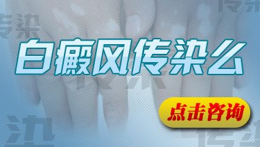 散发型白癜风会不会传染