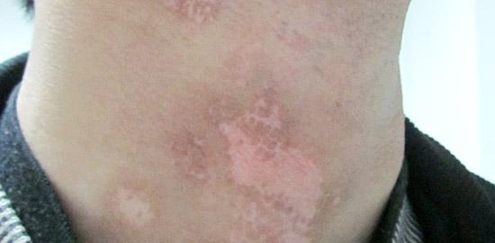 白癜风照窄谱uvb出水泡怎么办