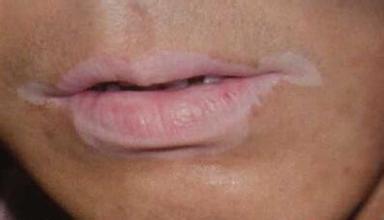 你知道的白癜风,是这样子的吗