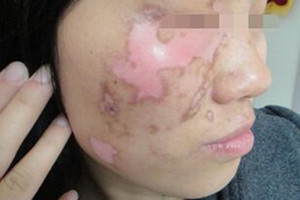 白癜风擦药后变得很红还痒好吗