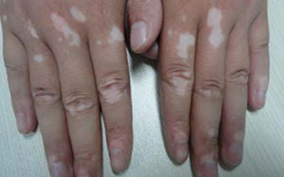 身体哪些部位容易出现白癜风