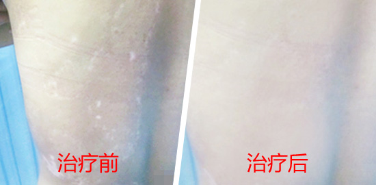瓷白色泛发型白斑，是否真的&ldquo;无可救药