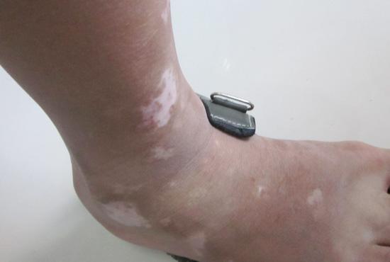 激光照射白癜风出现发红症状怎么办