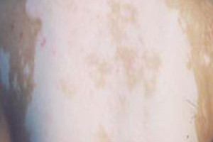 激光治疗长时间的白癜风能好吗