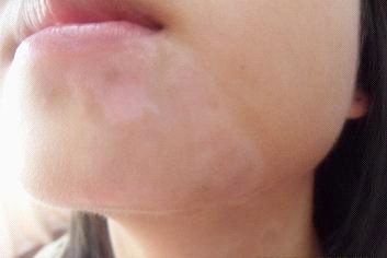 308照白癜风起泡疼痛正常吗