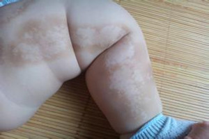 沧州白癜风医院能不能在网上看病