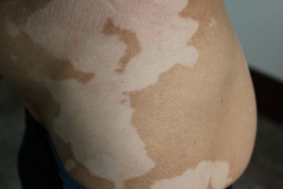 春季白癜风患者护理皮肤的方式