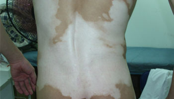 石家庄能用308激光治疗进展期白癜风吗