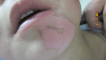 如何有效预防白癜风复发