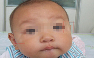 小孩脸上出现块白斑是怎么了