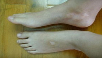 肢端型白癜风适合采用什么方法治疗