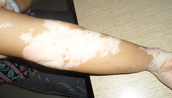 手臂上有白癜风用什么方法治疗