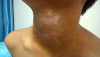 早期的白癜风都有哪些具体症状