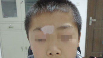 邯郸怎么治疗脸部白癜风效果好