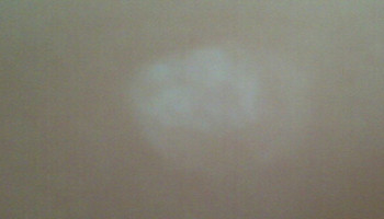 青少年白癜风早期症状图解