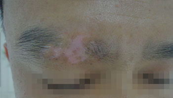 身上长白癜风要怎么来治疗