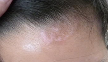 女性额头白癜风早期症状图解