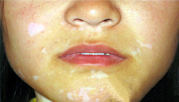 女性脸部白癜风早期症状图解