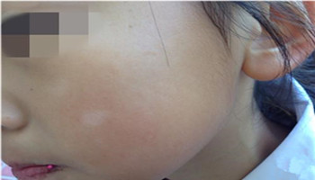 白癜风患处的白斑是对称出现的吗