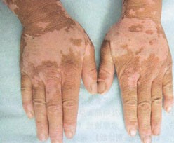 手上的白癜风去衡水哪里能治好呢