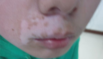 用药治疗白癜风过程中还扩散吗